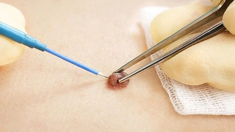 Mole removal