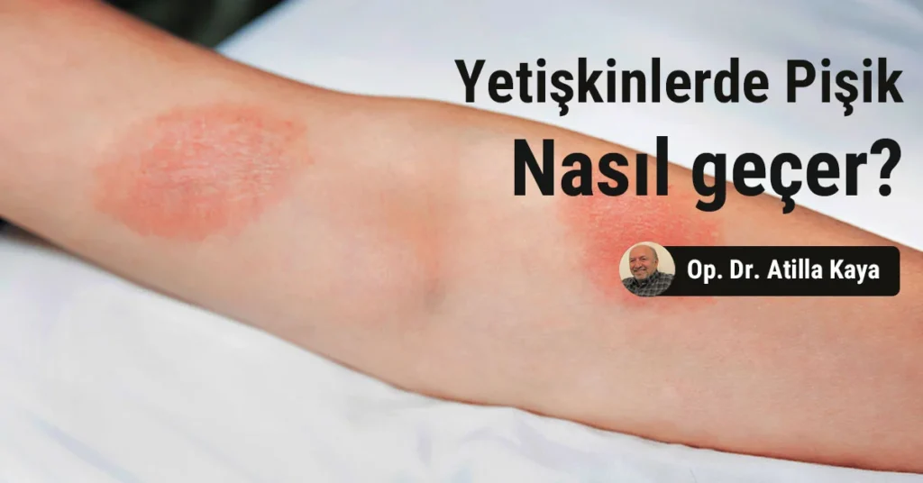 Pişik neden olur? Pişik kremi işe yarar mı?