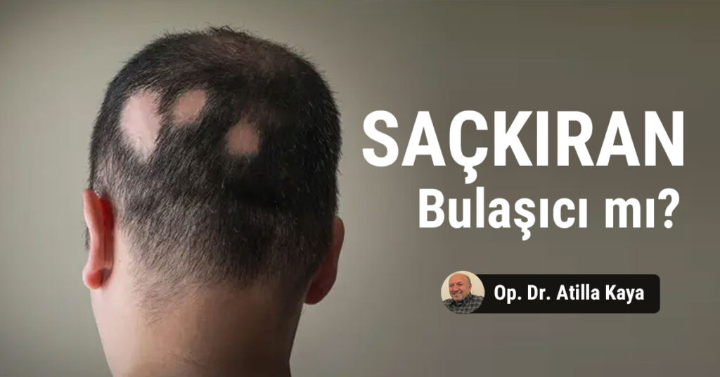 Saçkıran bulaşıcı mı? Saçkırandan korunmak için ne yapmalı?