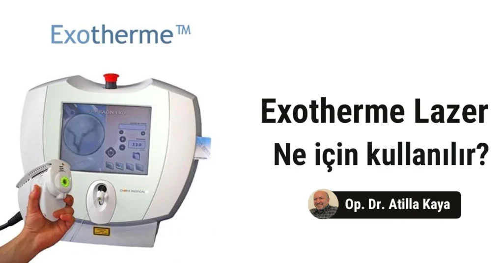 Exotherme lazer ile acısız tedavi