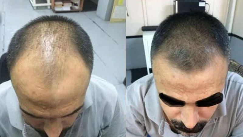 Saç dökülmesi öncesi ve sonrası görüntüleri