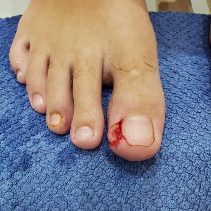 Tırnak batması çözümü