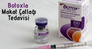 Botoxla Makat Catlagi Tedavisi