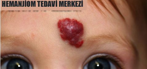 hemanjiom-tedavi-merkezi