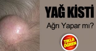 Kafada Yağ Kisti Tedavisi