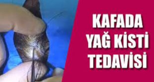 Kafada Yağ Bezesi Ameliyat Ücreti
