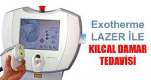 Kılcal Damar Tedavisi